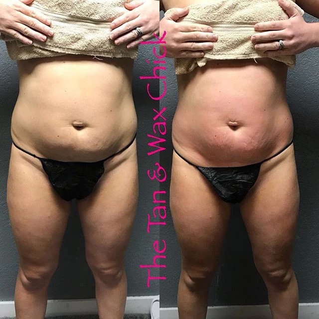 Ice Me Body Contouring