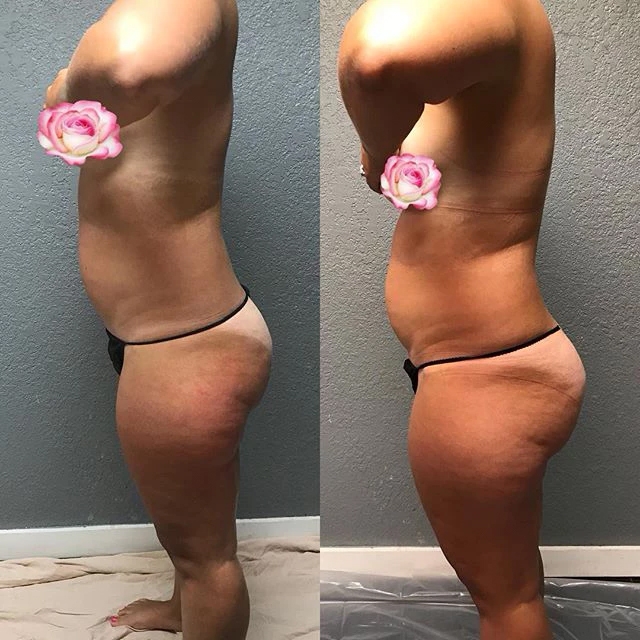 Ice Me Body Contouring