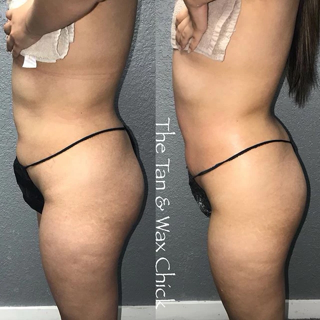 Ice Me Body Contouring