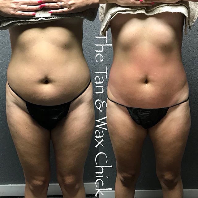 Ice Me Body Contouring