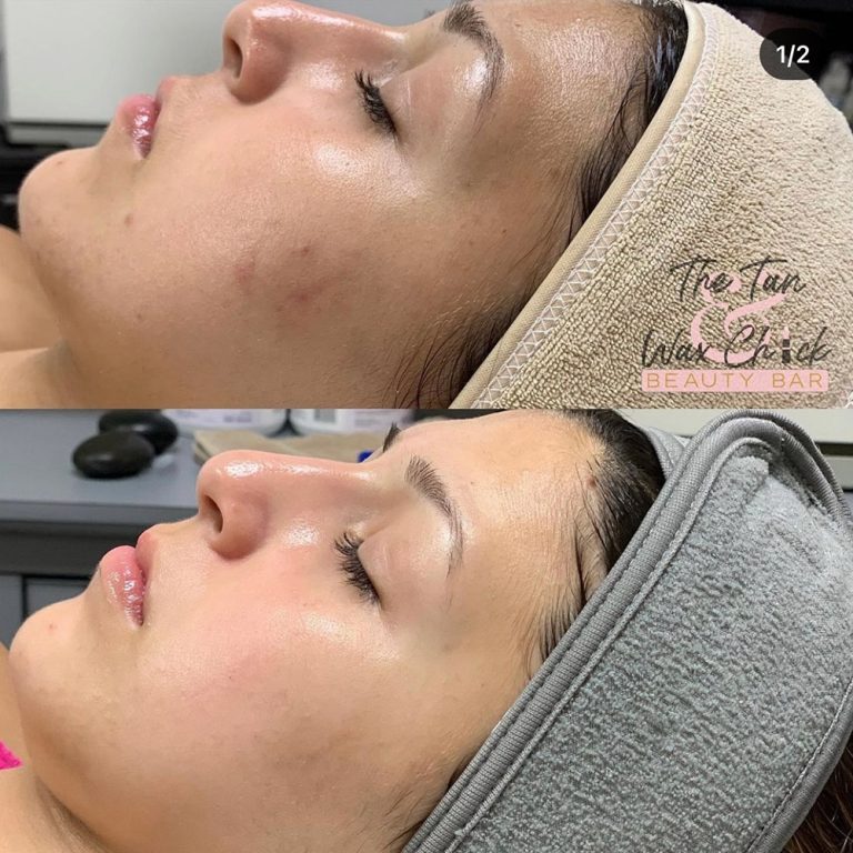 skin-care-before-and-after-04