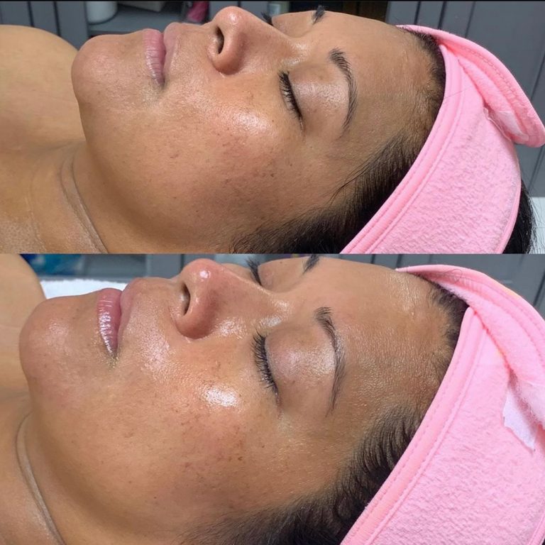skin-care-before-and-after-08