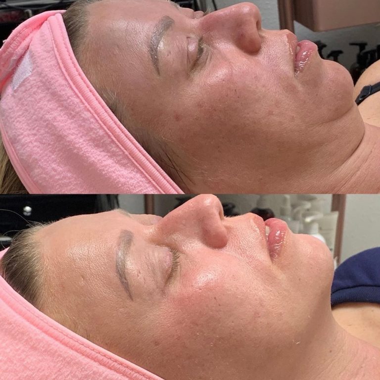 skin-care-before-and-after-11