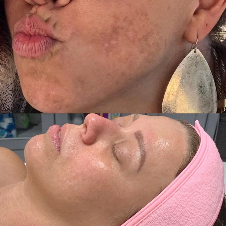 skin-care-before-and-after-12