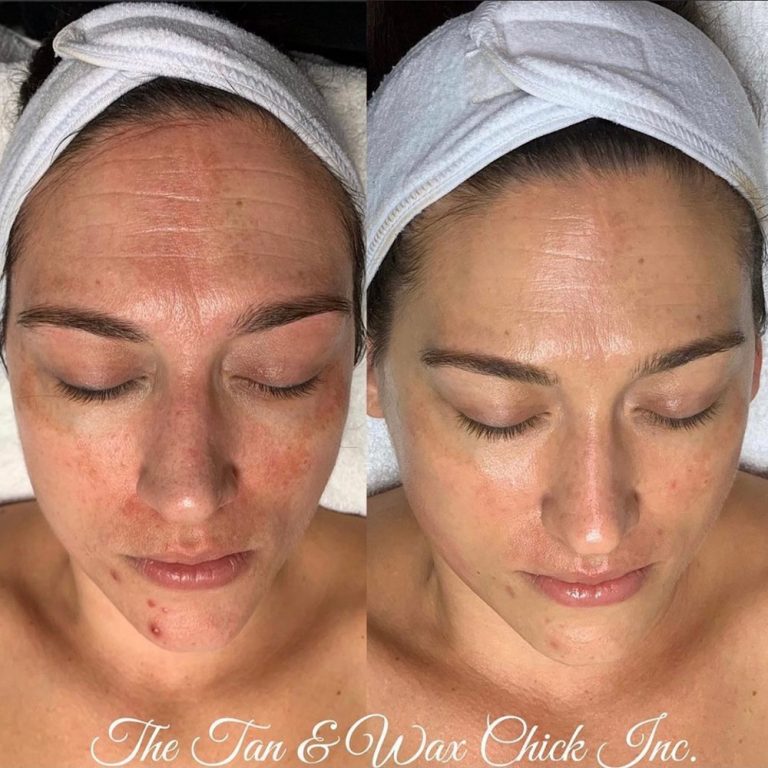 skin-care-before-and-after-14
